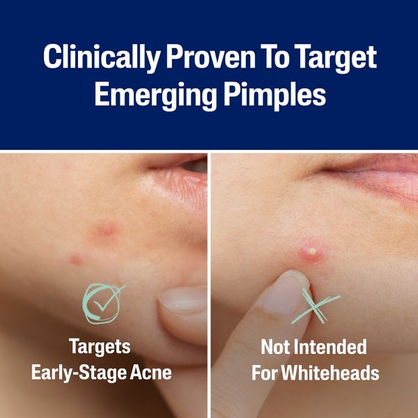 Cetaphil Acne Spot Pimple Patches with Salicylic Acid - 24ct